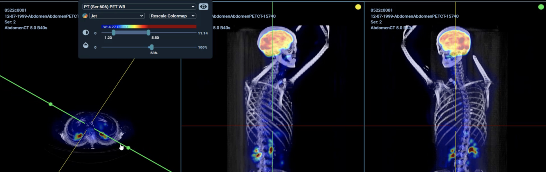 PET-CT image rendered in 3-D