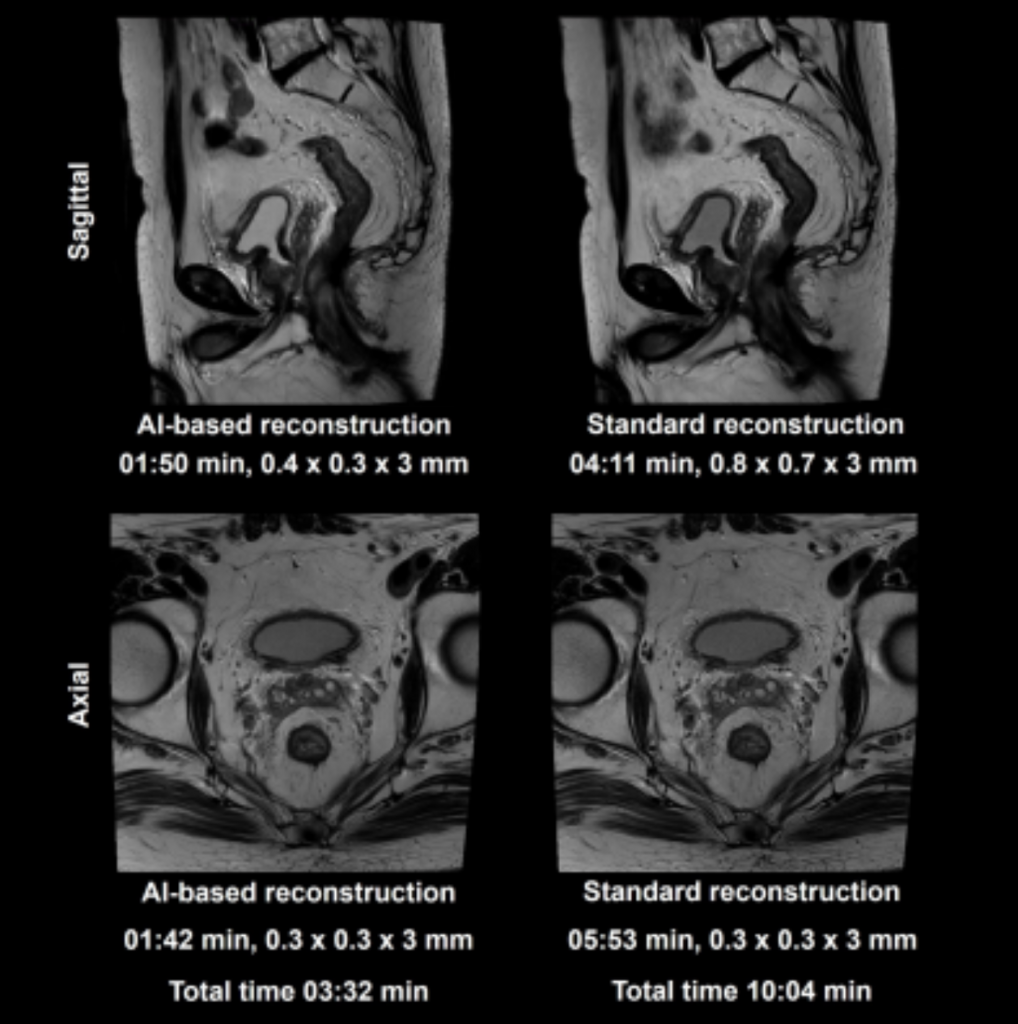 Example T2-weighted TSE images with (left) and without (right) AI-reconstruction techniques for a 70-year-old male patient with rectal
adenocarcinoma. 